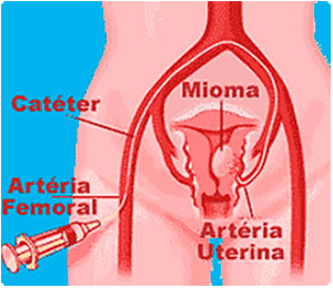 Como se processa a Cirurgia-de-embolização - Webmioma - Passo 03