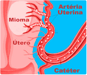 Como se processa a Cirurgia-de-embolização - Webmioma - Passo 04