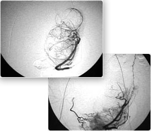 Como se processa a Cirurgia-de-embolização - Webmioma - Passo 05