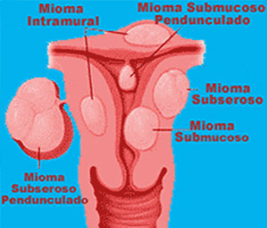 Mioma Uterino - Miomas - WebMioma